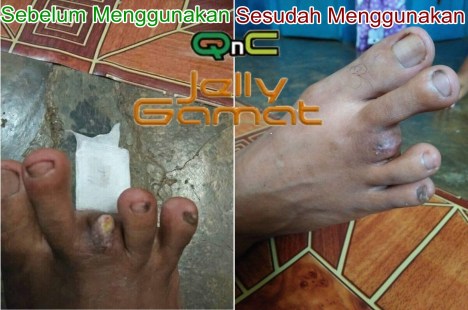 Testimoni QnC Jelly Gamat Patah + Infeksi Tulang