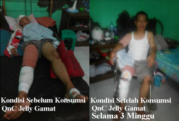 Testimoni QnC Jelly Gamat Patah Tulang Sukamto Sebelum & Sesudah Konsumsi